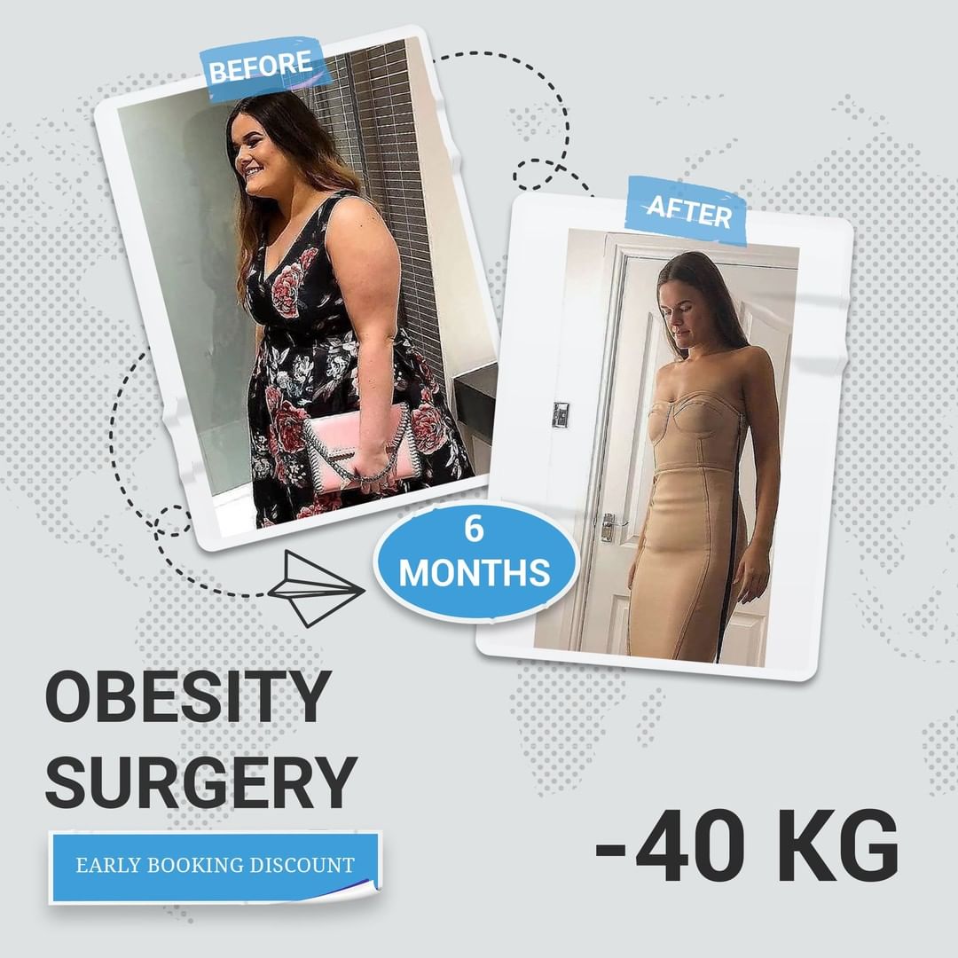 gastric-sleeve-turkey (2)